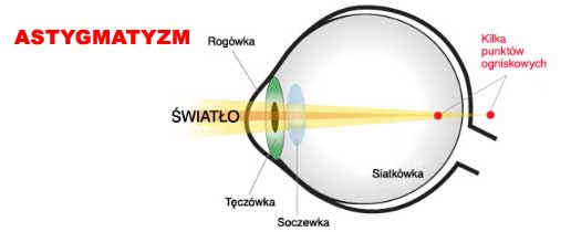 Optyk Katowice dalekowzroczność Astygmatyzm