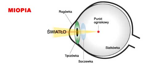 Optyk Katowice krótkowzroczność Mopia
